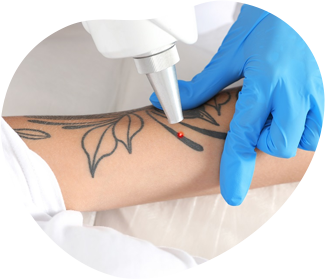 eliminación tatuaje